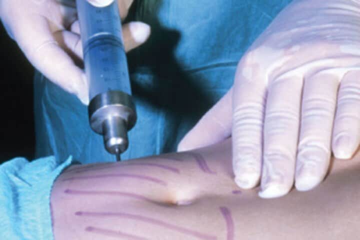 Liposuctie